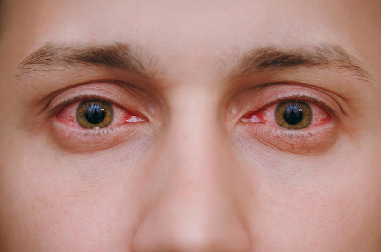 Que faire en cas de yeux rouges ?